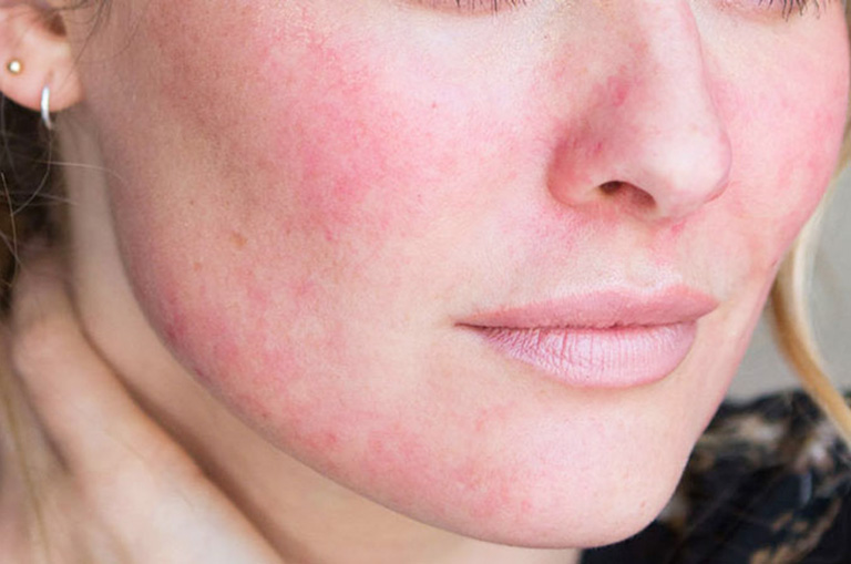 Loại da thường bị nổi mẩn đỏ khi giao mùa